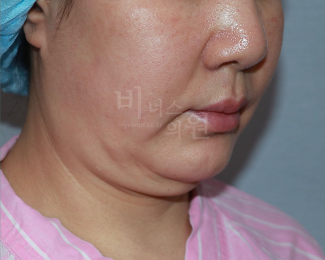 턱 지방흡입 수술 전 왼측면 비너스의원