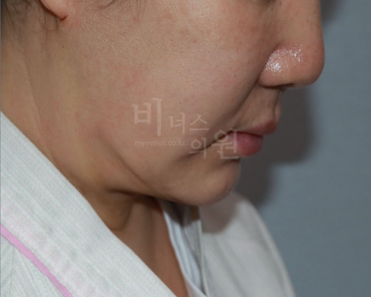 턱 지방흡입 수술 후 왼측면 비너스의원