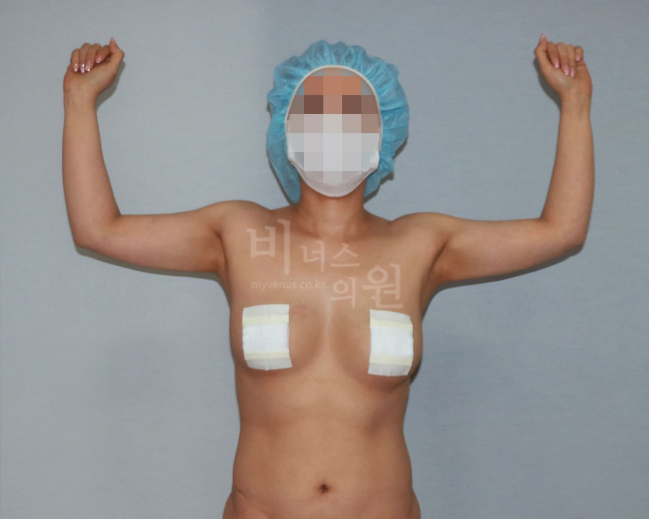 팔 지방흡입 수술 후 정면 비너스의원