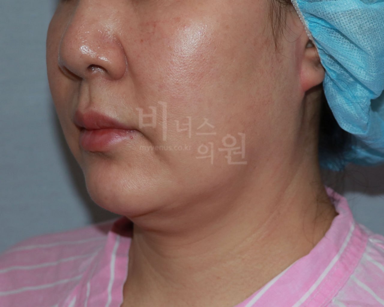 턱 지방흡입 수술 전 우측면 비너스의원