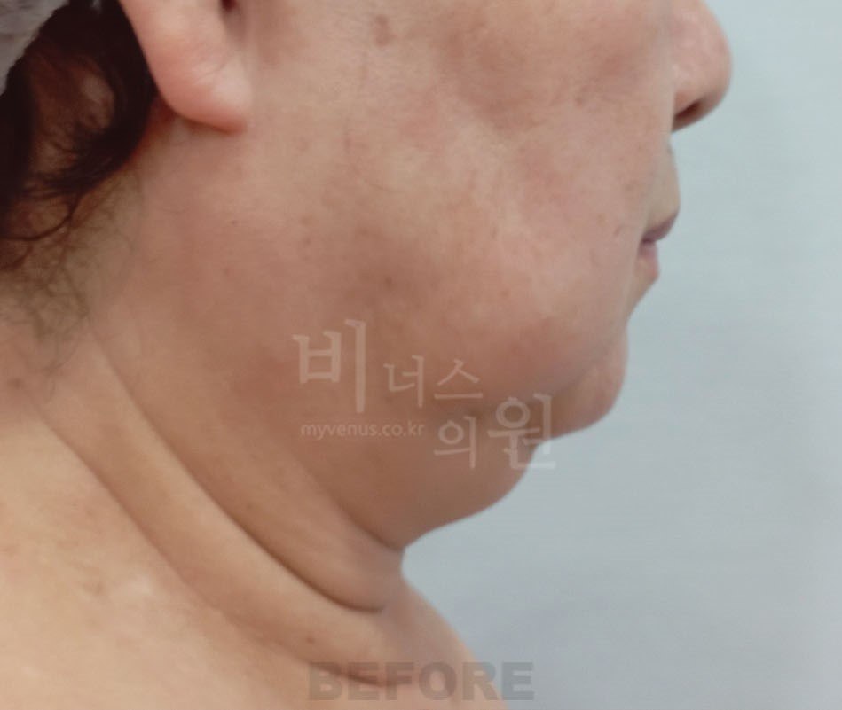 이중턱 지방흡입 전 옆면 비너스의원
