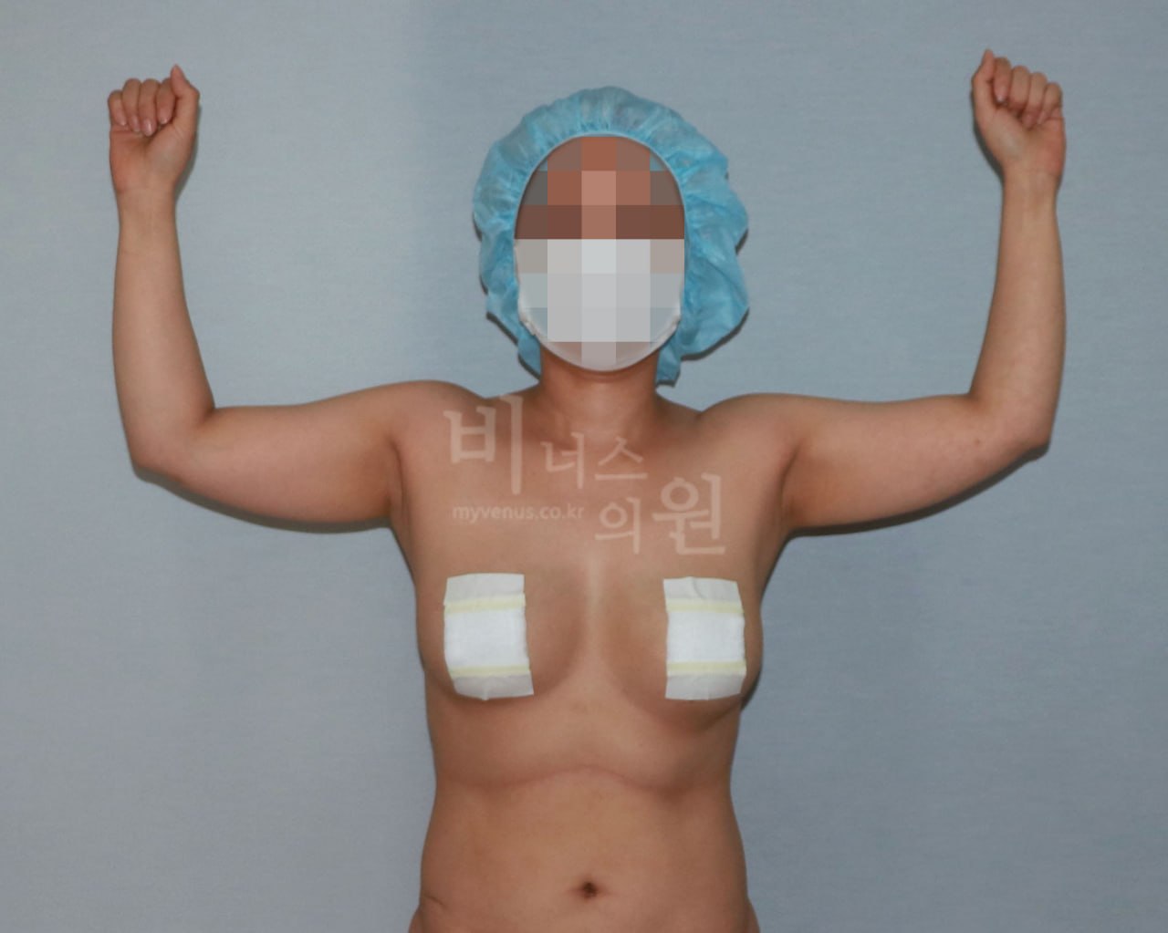 팔 지방흡입 수술 전 정면 비너스의원