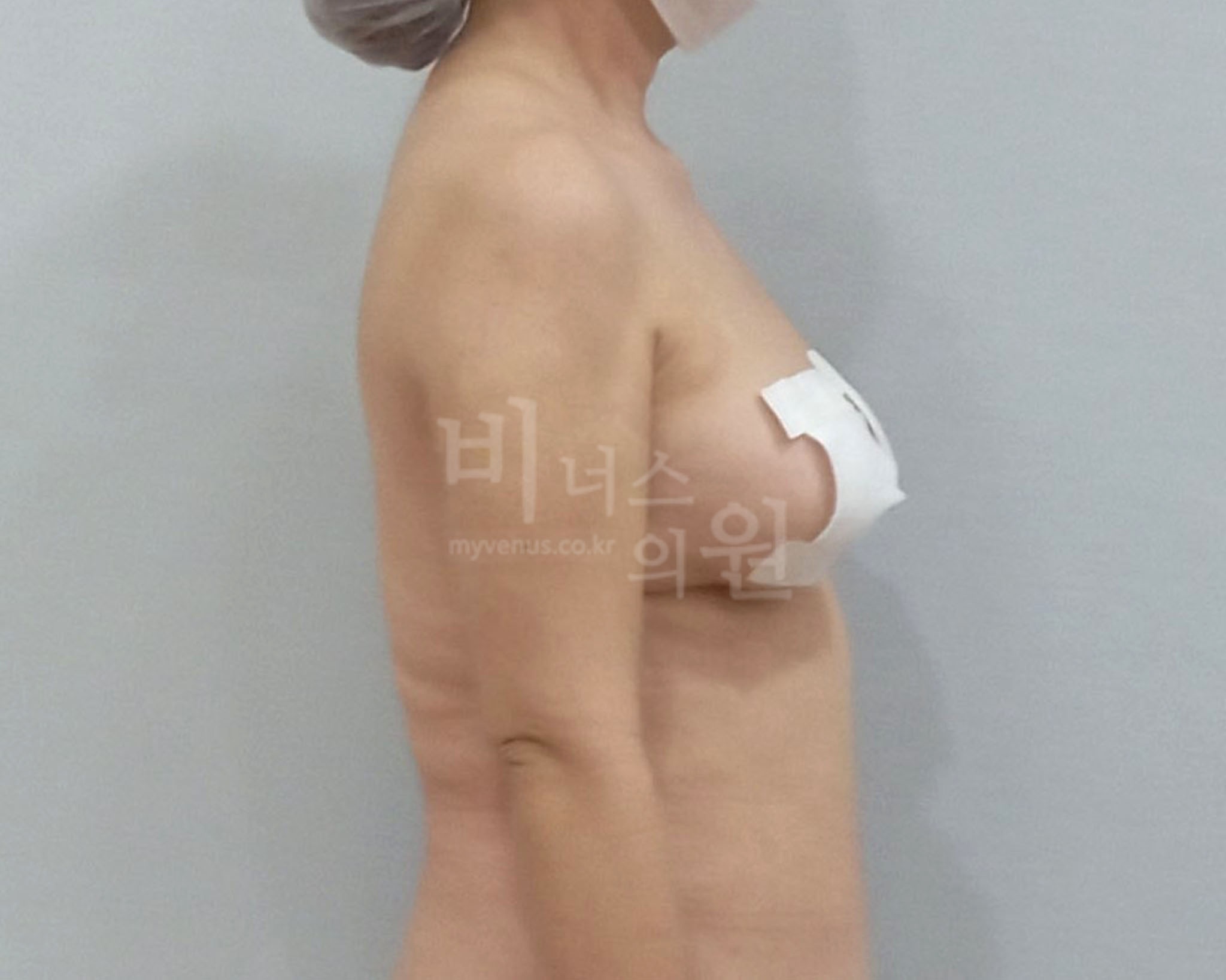 팔뚝지방흡입 수술 후 측면(팔을 내린 자세) 사진