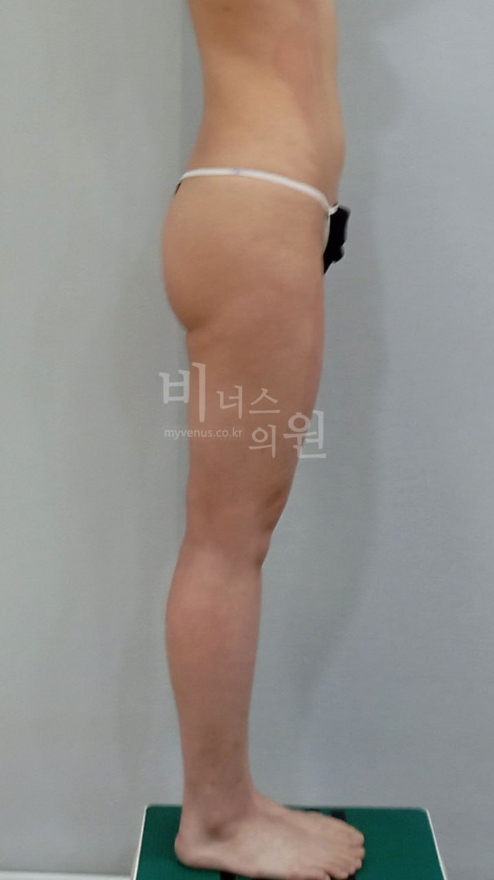 허벅지 지방흡입 수술 전 측면 비너스의원