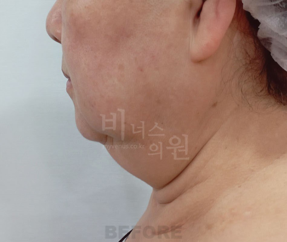 이중턱 지방흡입 전 측면 비너스의원