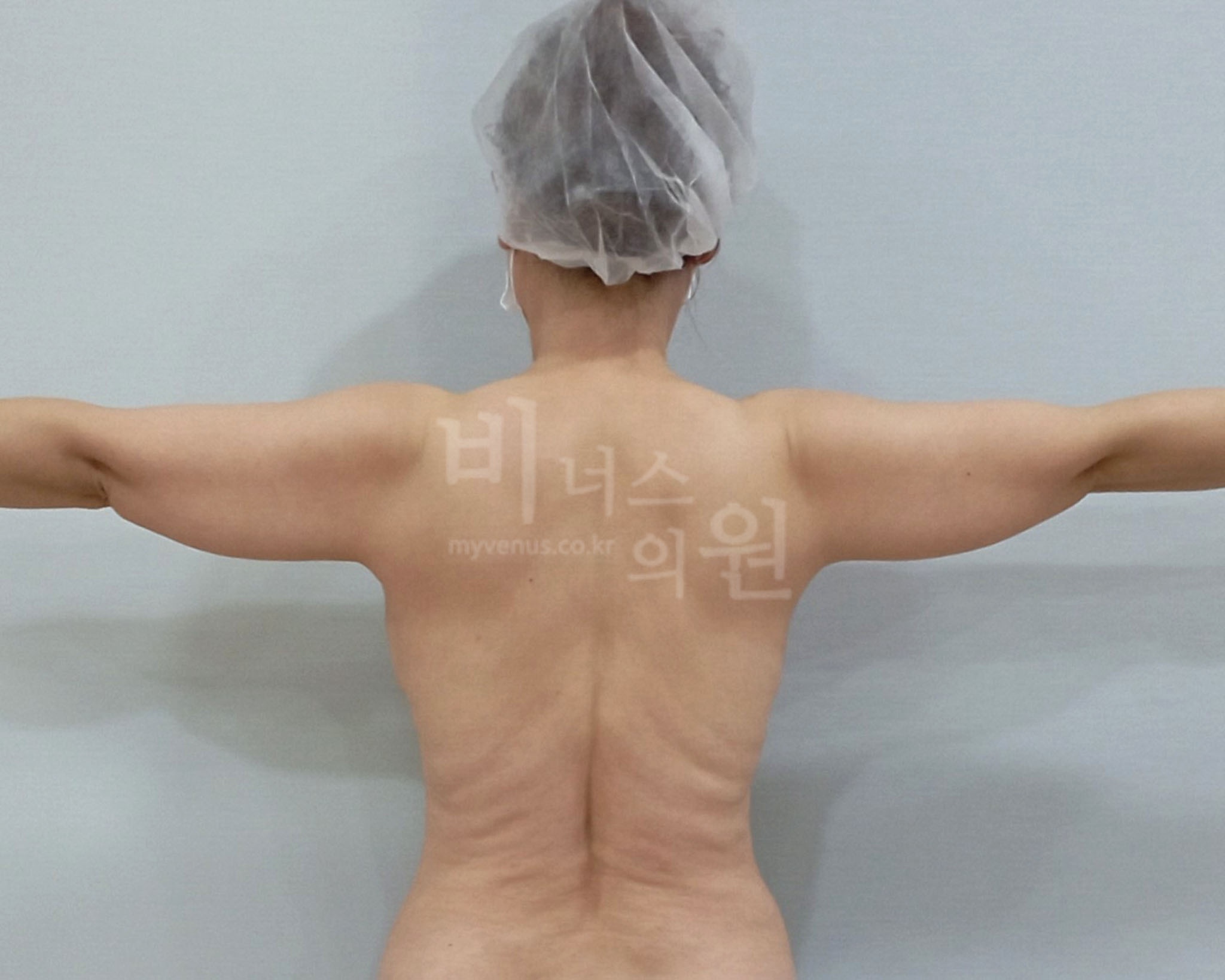 팔뚝지방흡입 수술 전 후면(양팔을 옆으로 펼친 자세) 사진