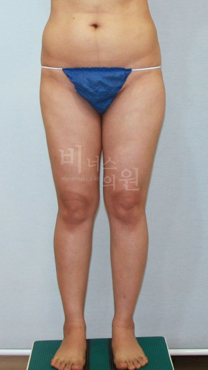 허벅지 엉덩이 하방 지방흡입 수술 전 정면
