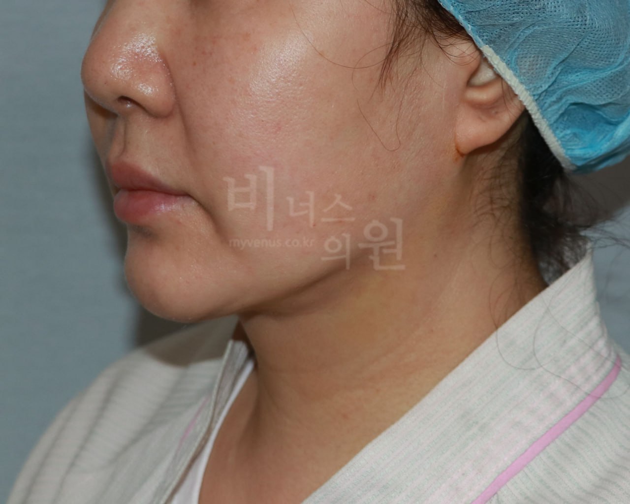 턱 지방흡입 수술 후 우측면 비너스의원