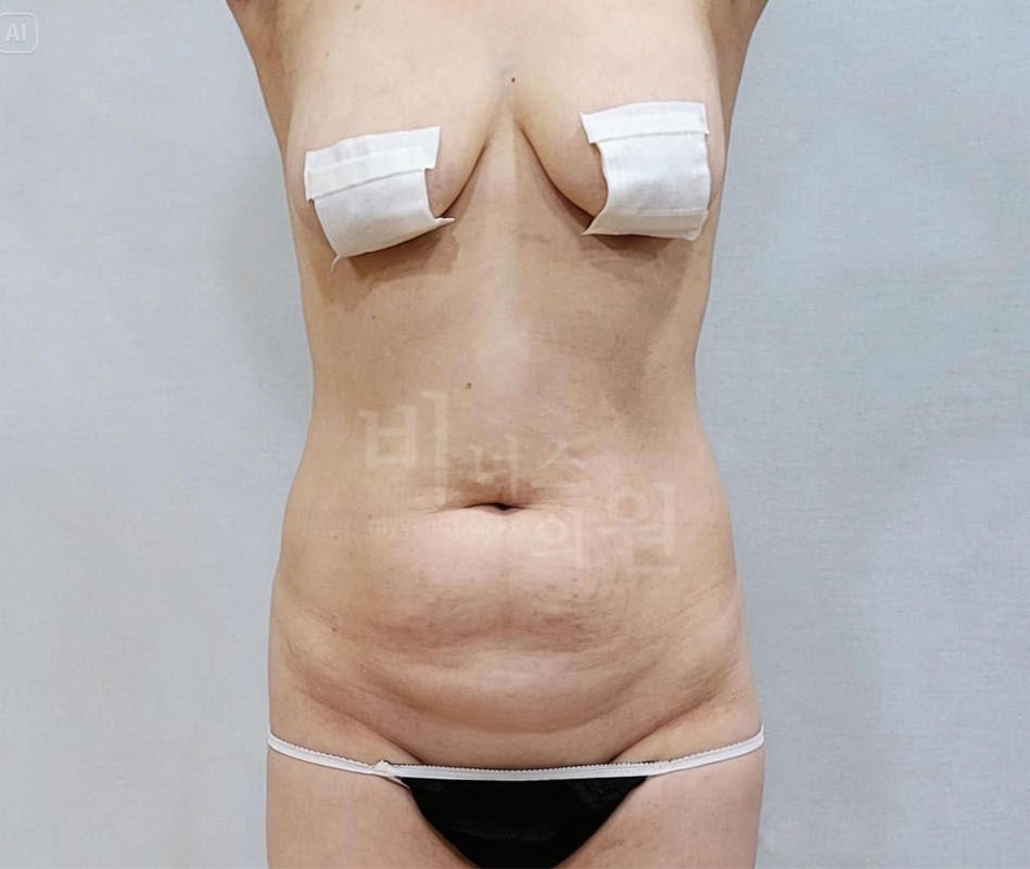 원통형 흉복부 지방흡입 수술 전 정면 비너스의원