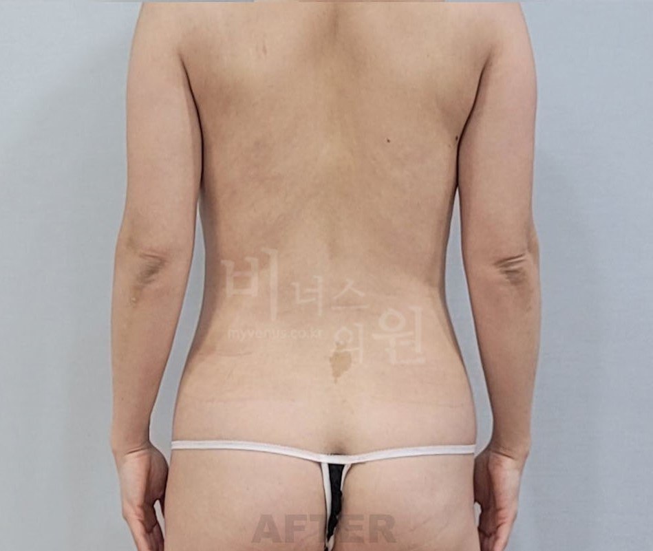 원통형 흉복부 지방흡입 수술 후 후면 비너스의원