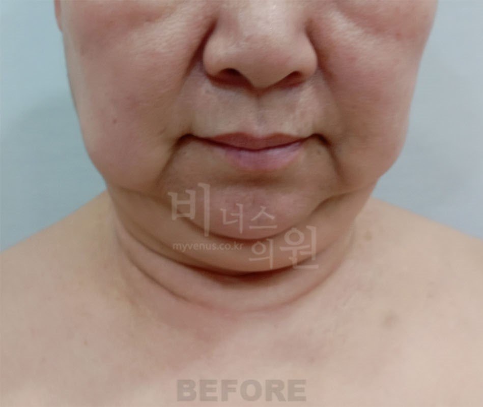 이중턱 지방흡입 전 정면 비너스의원