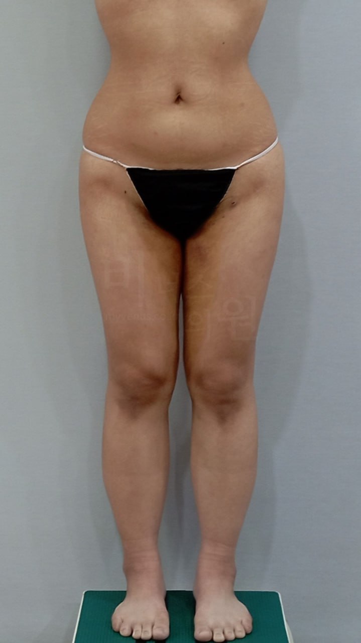 허벅지 원통형A 지방흡입 수술 후 정면