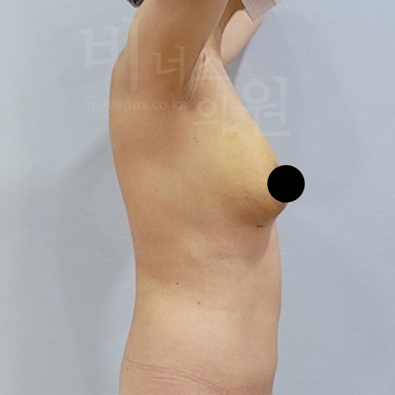 수술 후 측면