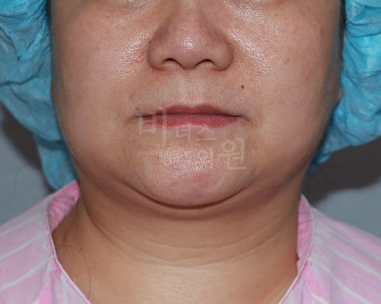 턱지방흡입 정면 전