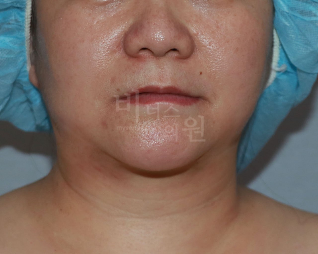 턱지방흡입 정면 후