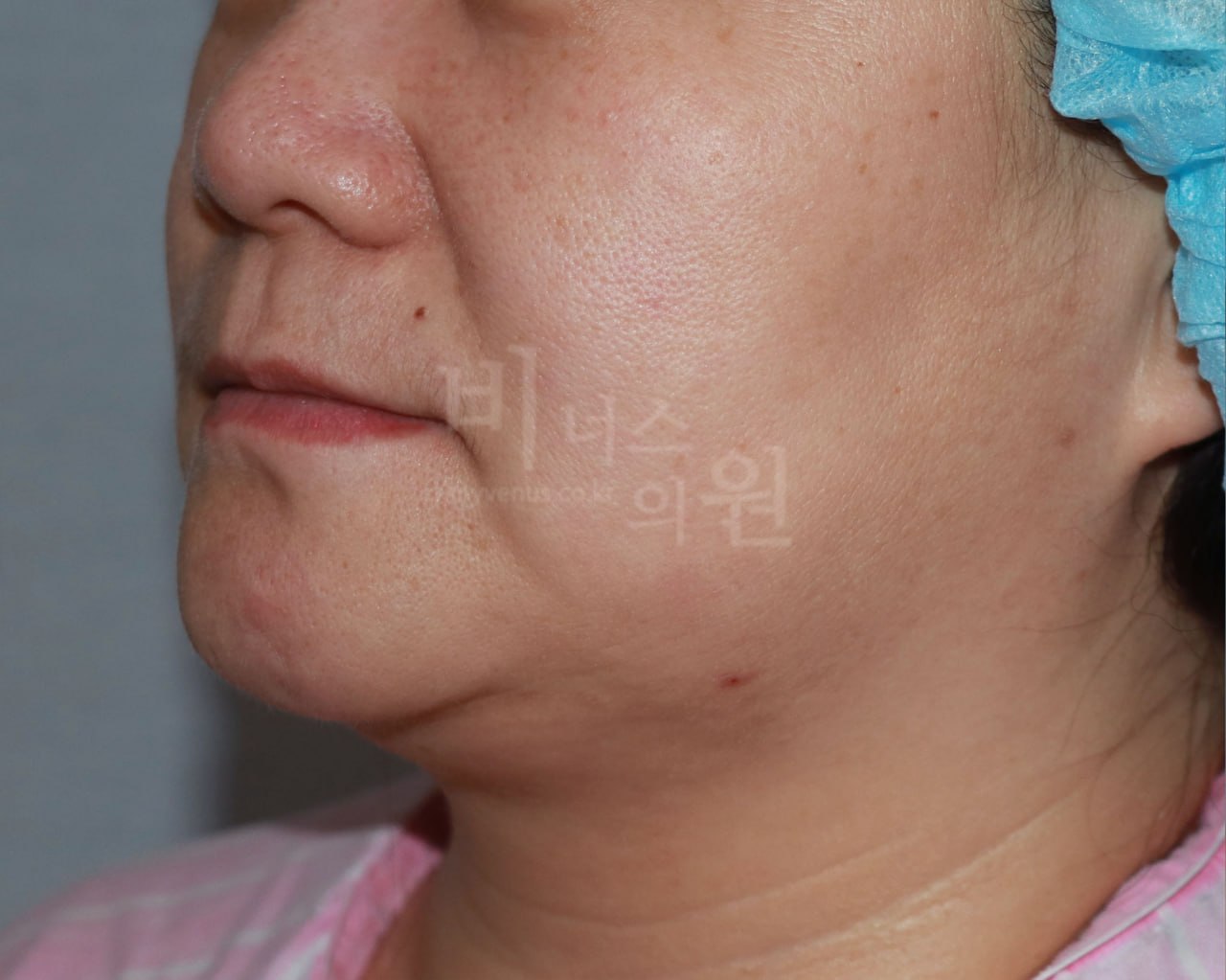 턱지방흡입 우측면 전