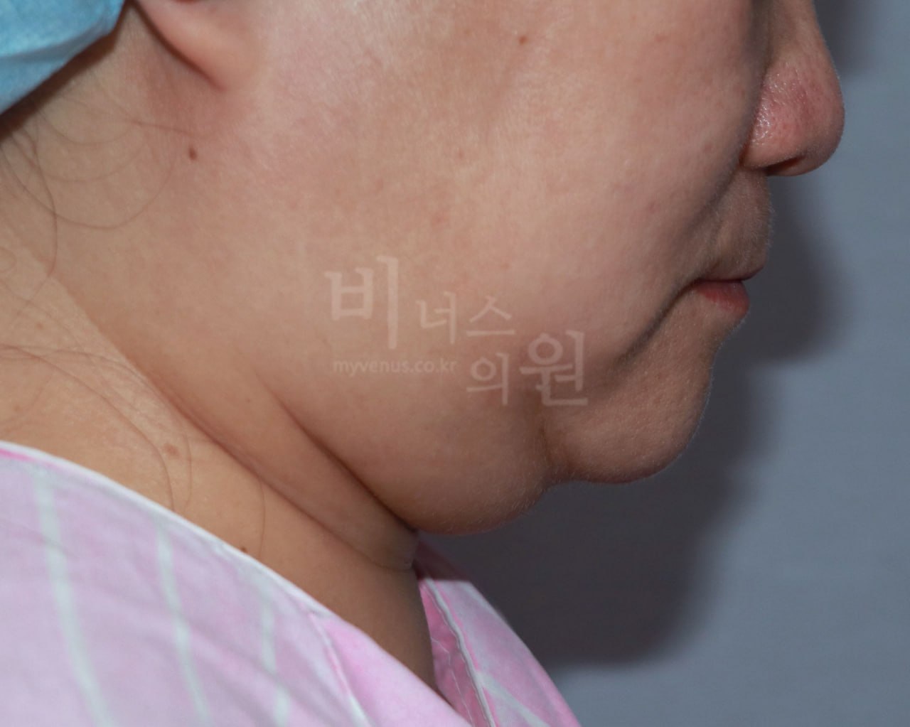 턱지방흡입 왼측면 전