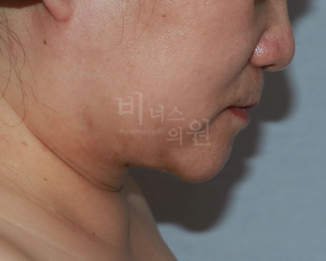 턱지방흡입 왼측면 후
