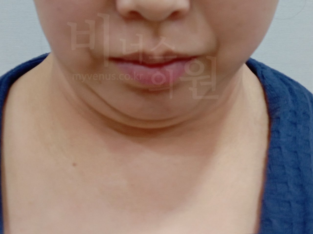 턱지방흡입 정면 전