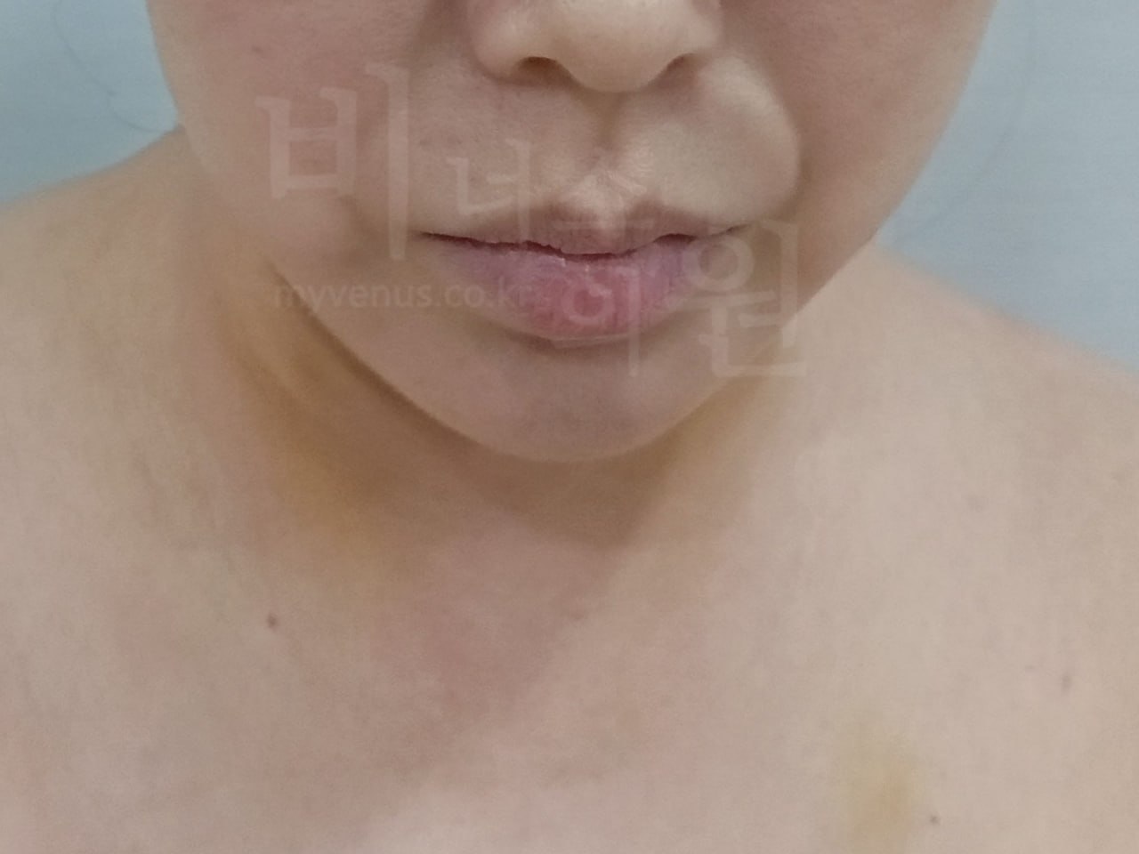 턱지방흡입 정면 후
