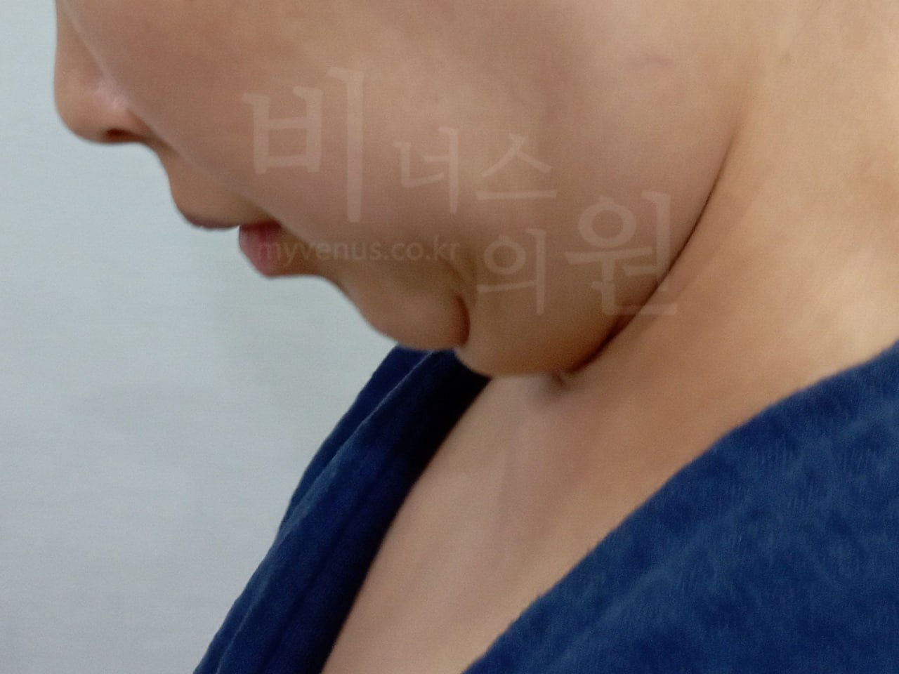 턱지방흡입 우측면 전