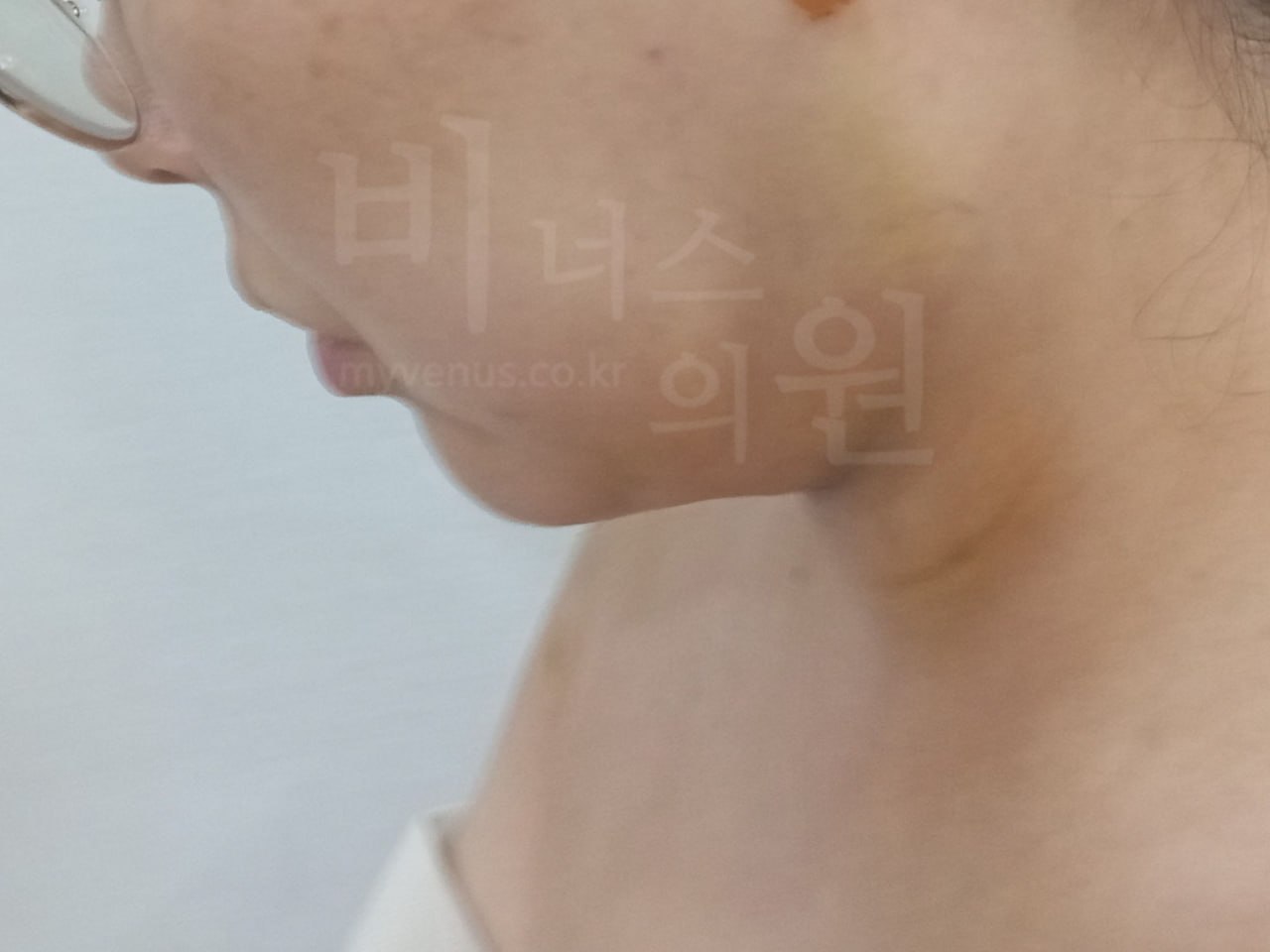 턱지방흡입 우측면 후
