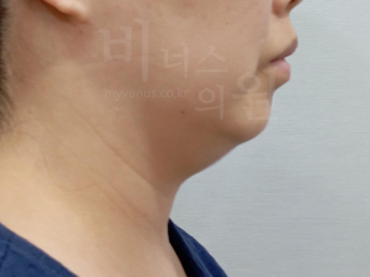 턱지방흡입 왼측면 전