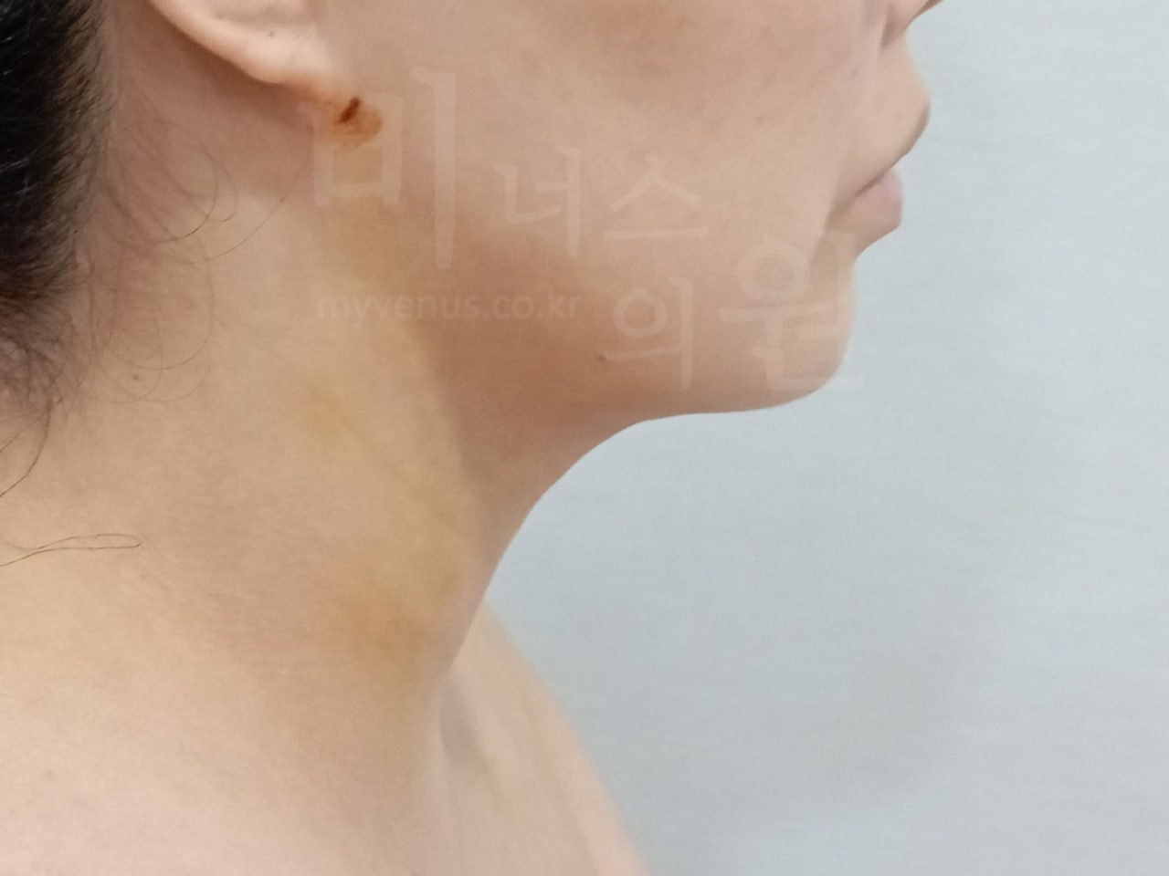 턱지방흡입 왼측면 후