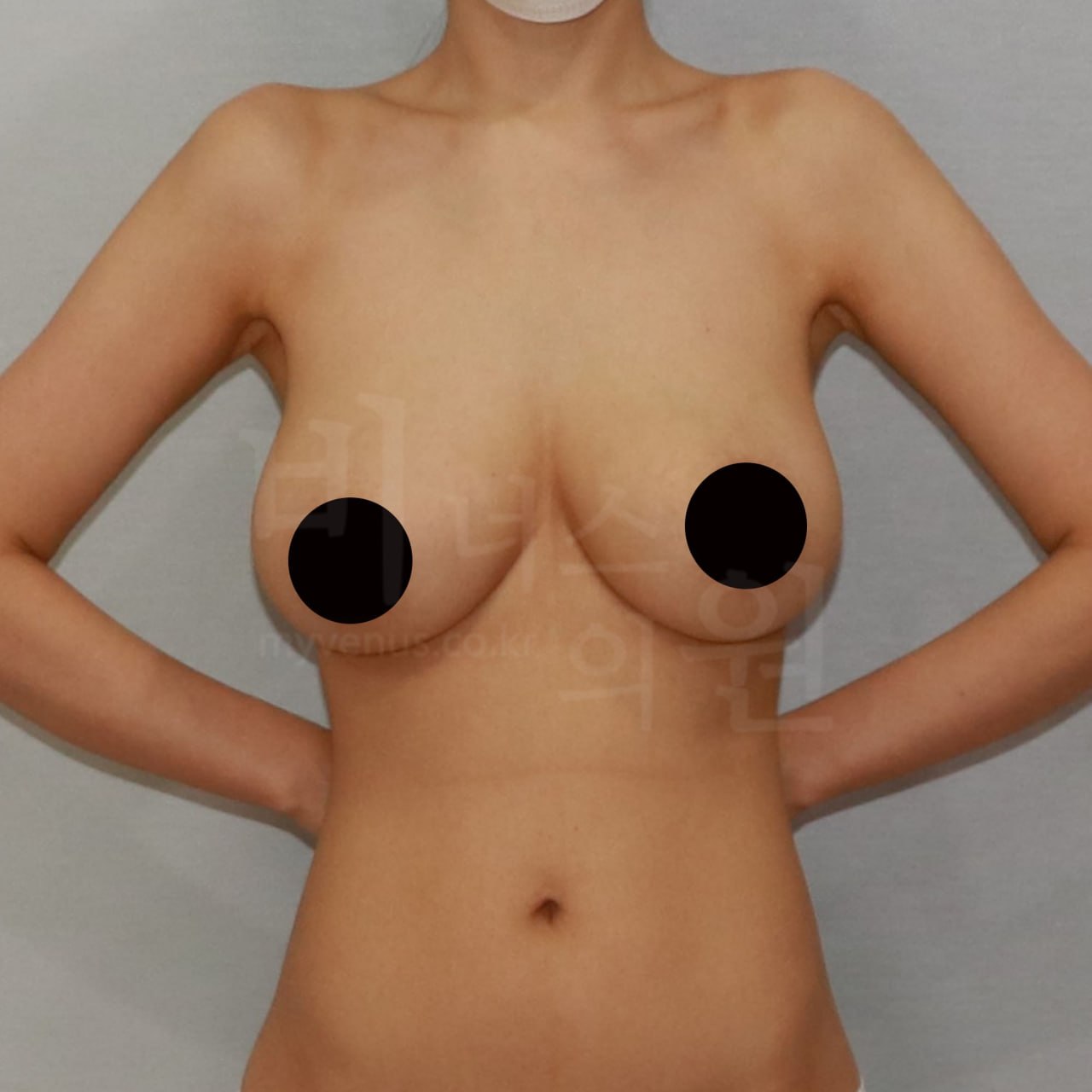 가슴축소 수술 전 — 정면 팔내림