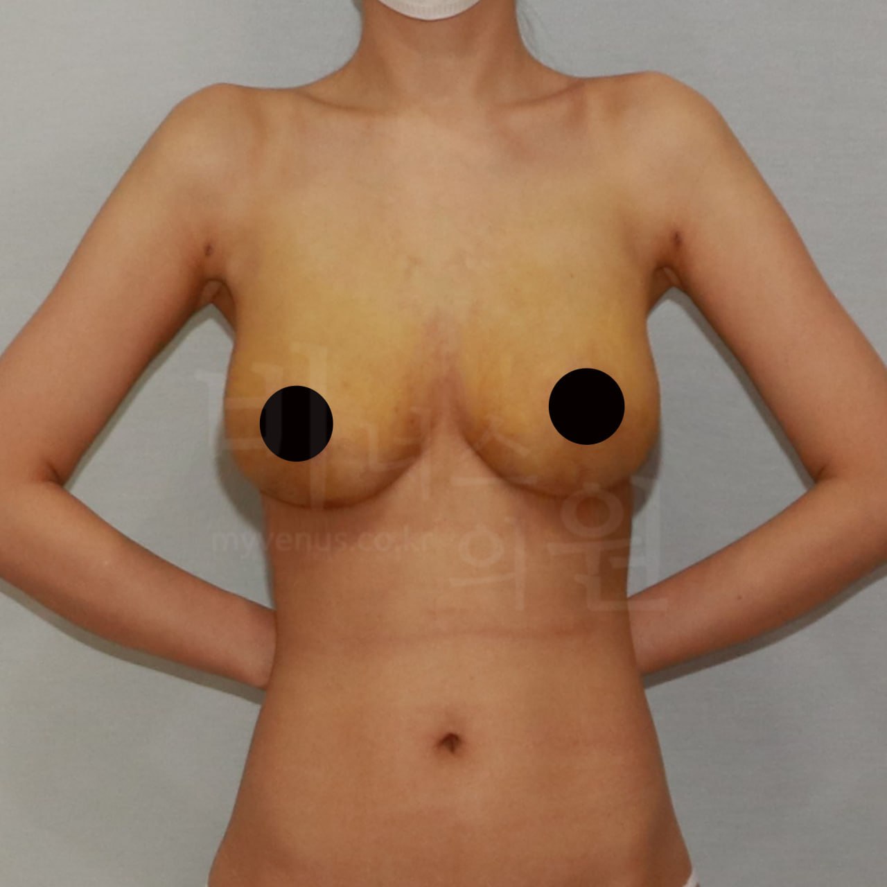 가슴축소 수술 후 — 정면 팔내림