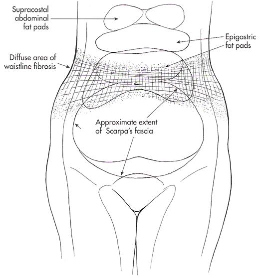 복부 지방층의 섬유조직